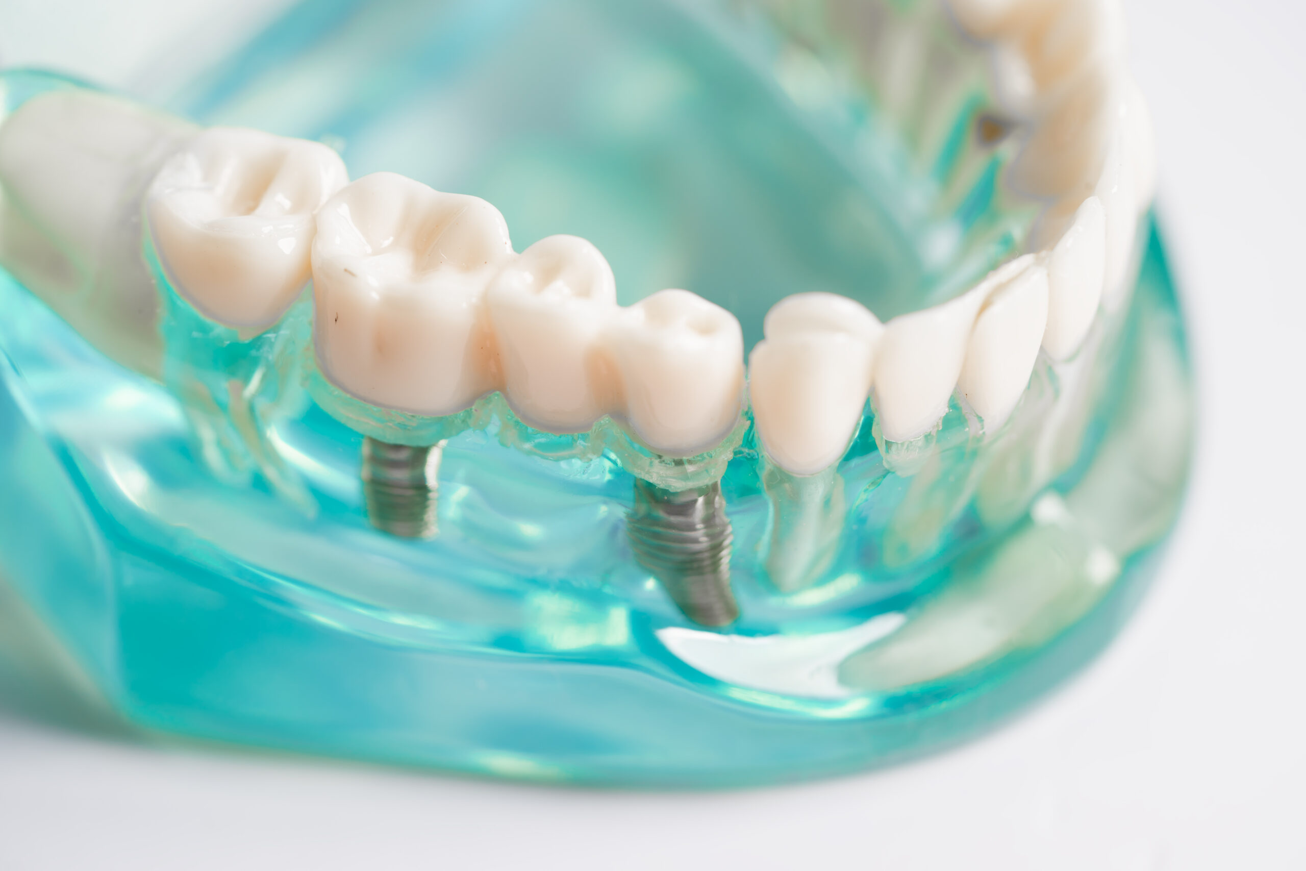 Dental implant, artificial tooth roots into jaw, root canal of dental treatment, gum disease, teeth model for dentist studying about dentistry.
