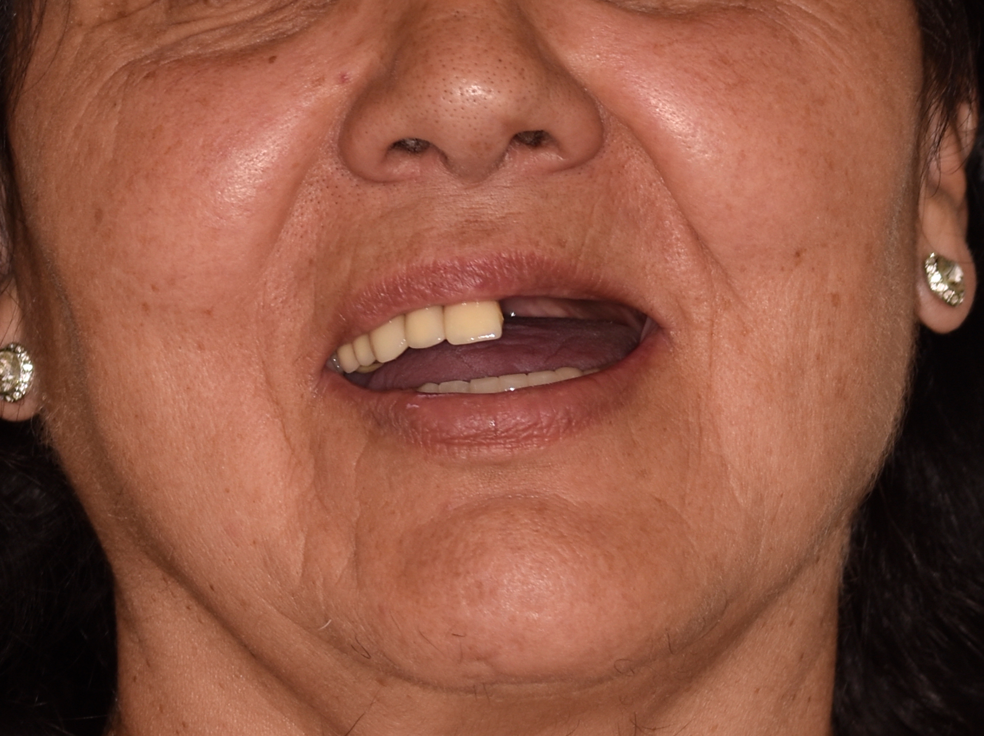 Antes