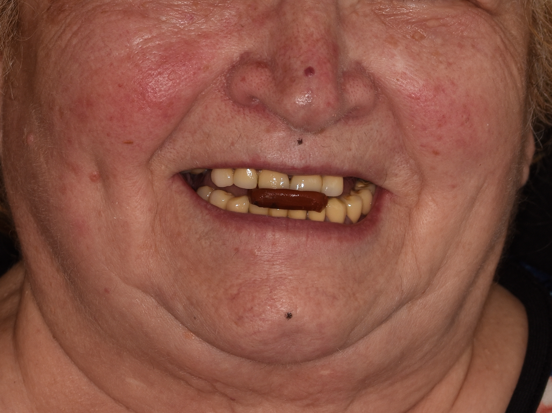 Antes