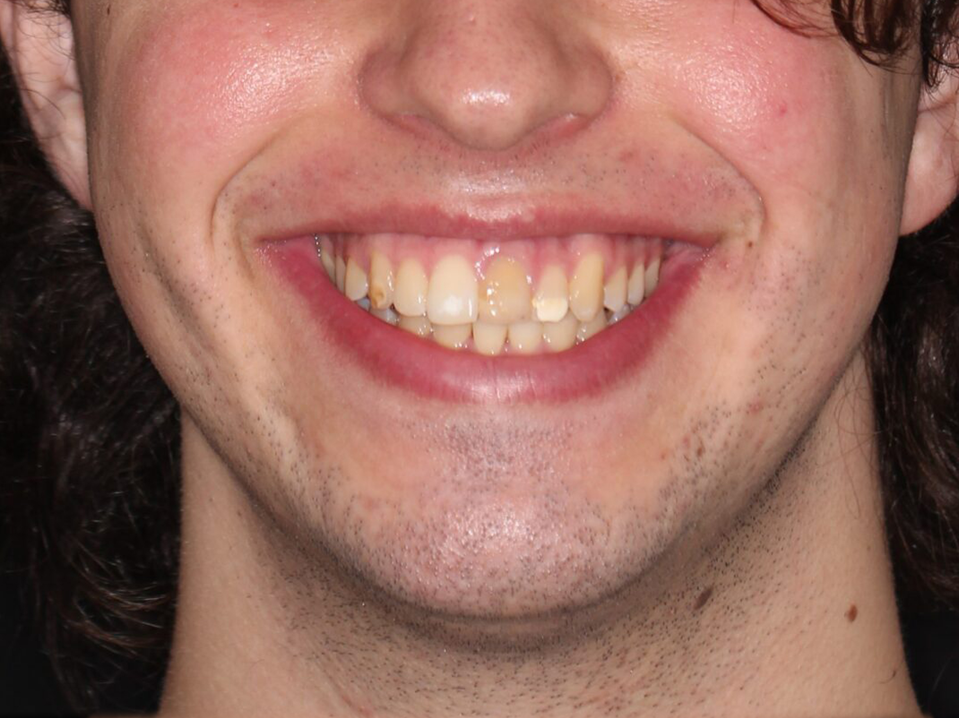 Antes